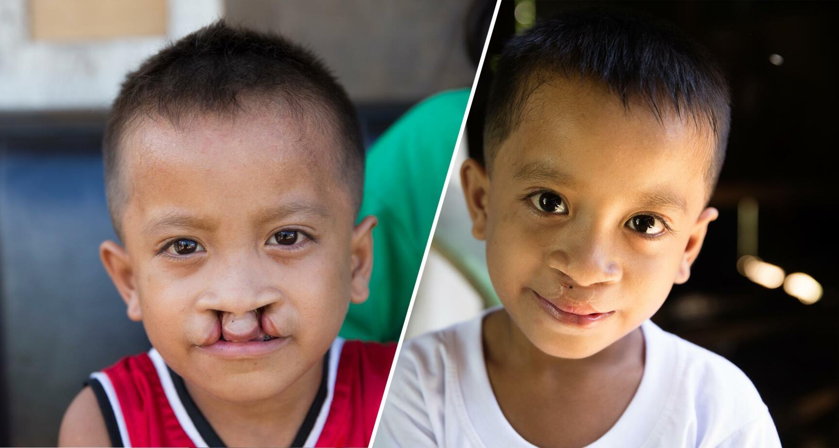 Operation Smile: Efter operationen kastar ingen längre sten
