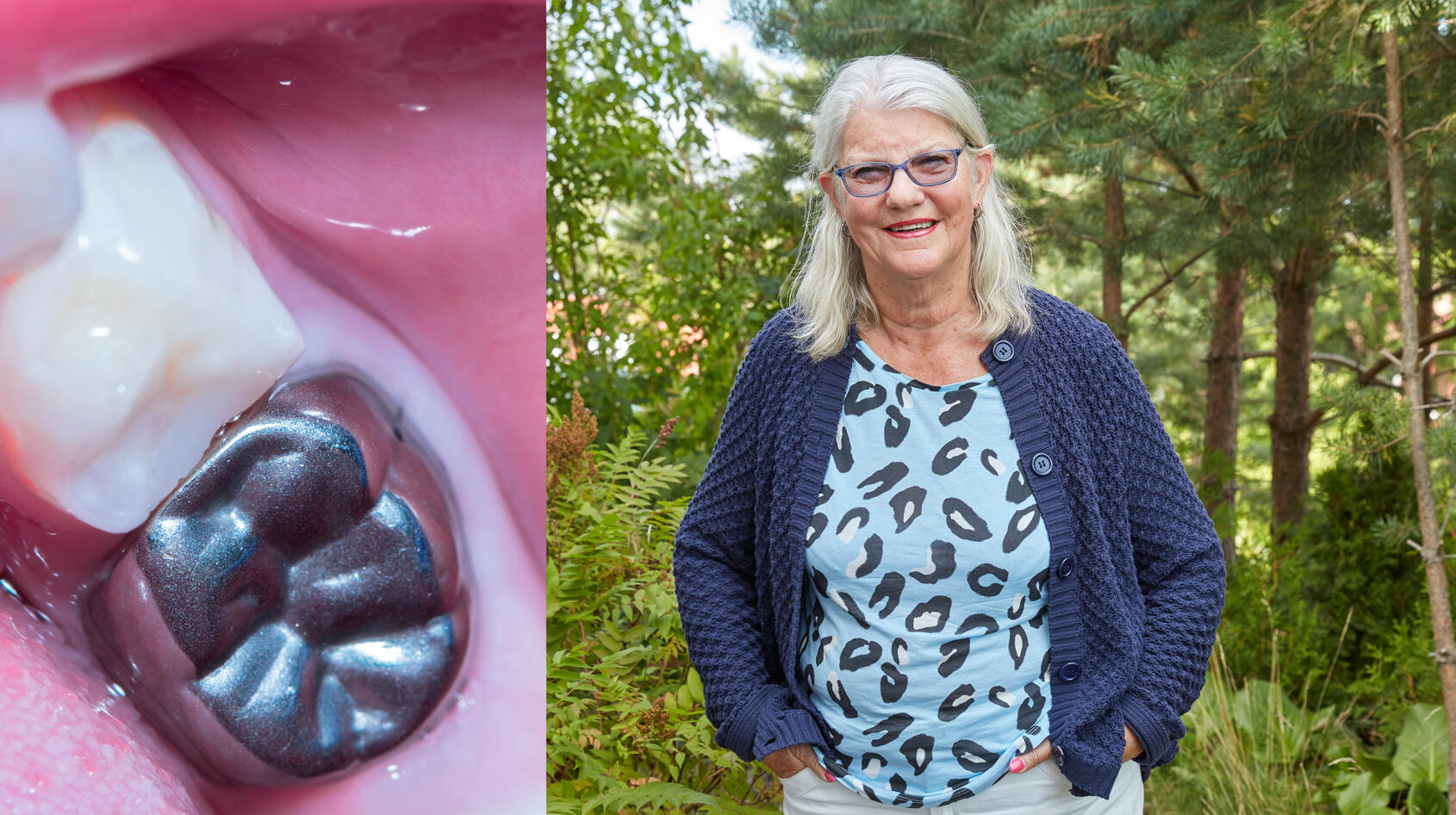 Evas besvär försvann med amalgamsaneringen