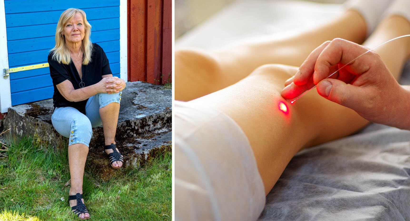 Marinas åderbråck försvann med laser: “Nu går jag gärna med shorts igen”