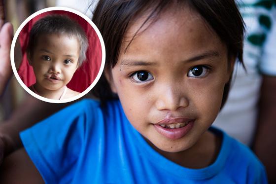 Operation Smile: Efter operationen kastar ingen längre sten